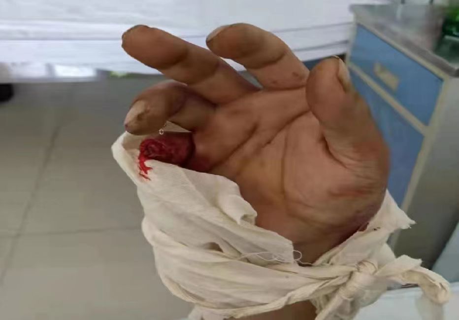 太原市万柏林区圪僚沟村春盛苑小区发生民工重伤事故,无人过问,监管何在?