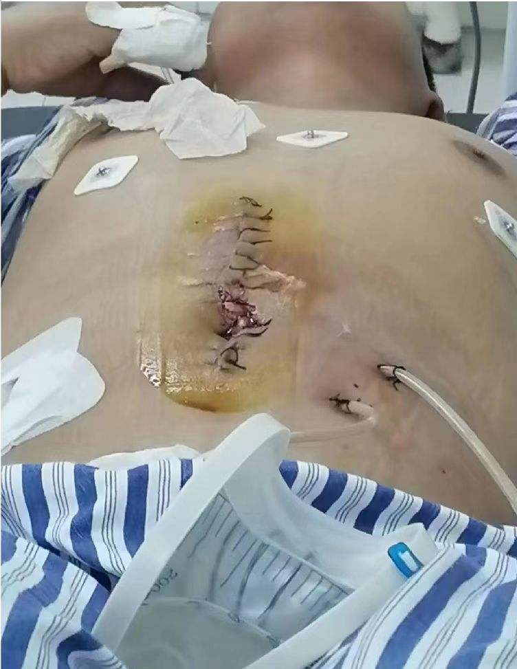 太原市万柏林区圪僚沟村春盛苑小区发生民工重伤事故,无人过问,监管何在?